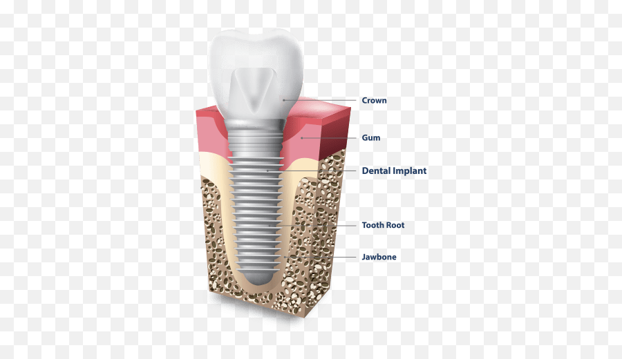 Dental Implants In Bayside Queens Nyc - Part Of Implant Png,Jawbone Icon Earhook