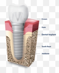 Dental Implants In Bayside Queens Nyc - Part Of png