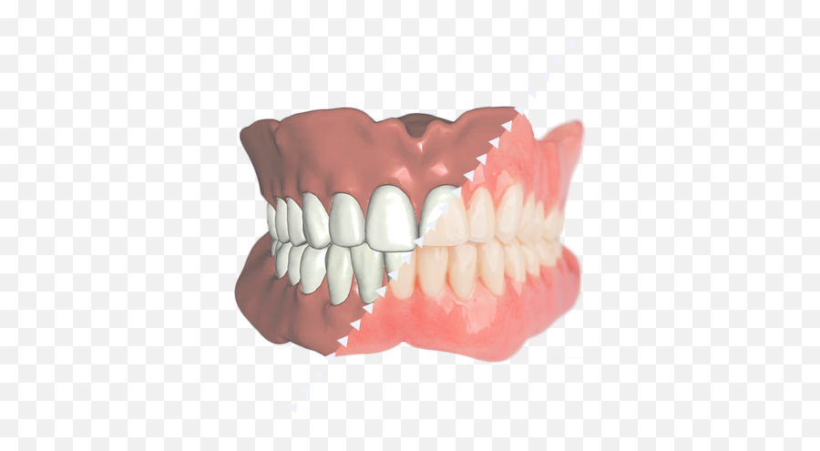 Digital Denture - Jaw Png,Dentures Png