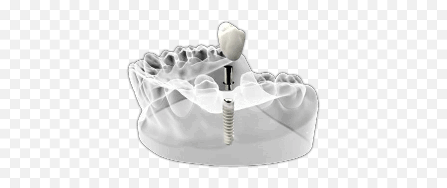 Dental Implants In Chico Png Forth Bridge Restoring An Icon
