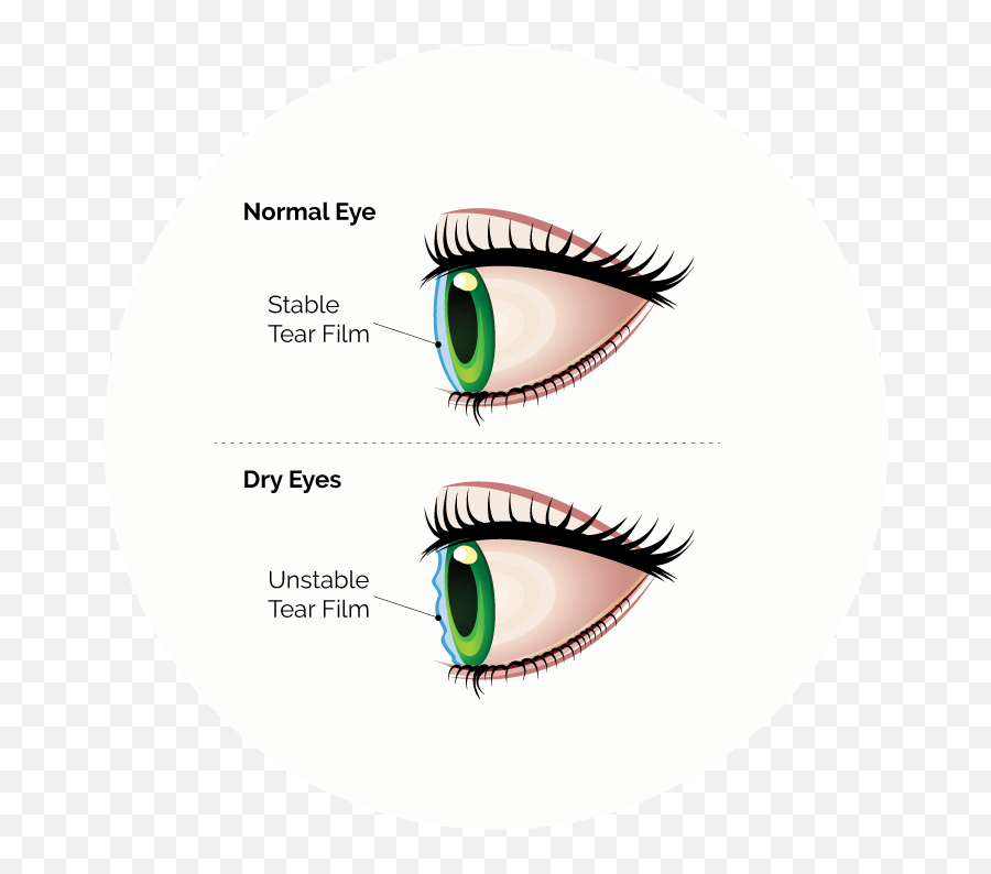 Dry Eye Treatment The Center - Dry Eye Vs Normal Eye Png,Cartoon Eye Png