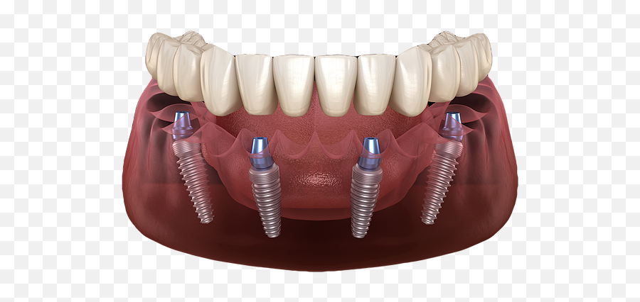 Dentures - All On 4 Implant Png,Dentures Png