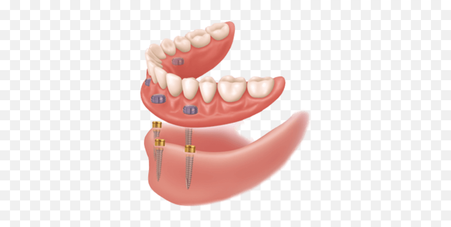 Denture Solutions - Snap In Dentures Cost Png,Dentures Png