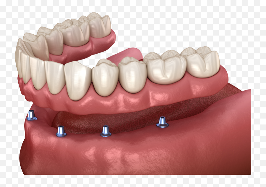 Dentures Sheboygan Wi - Dental Implant Png,Dentures Png