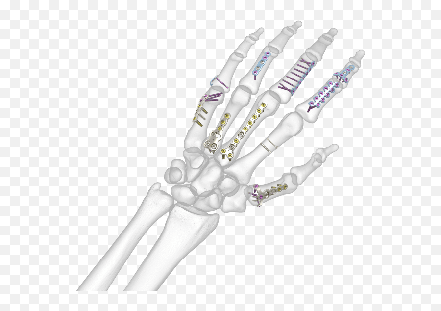 Hand Implants For Doctors And - Hand Bones Png,Skeleton Hand Png