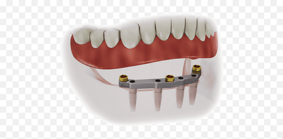Implant Supported Dentures - Implant Supported Overdenture Png,Dentures Png