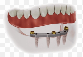 Implant Supported Dentures - Implant Supported Overdenture Png,Dentures Png