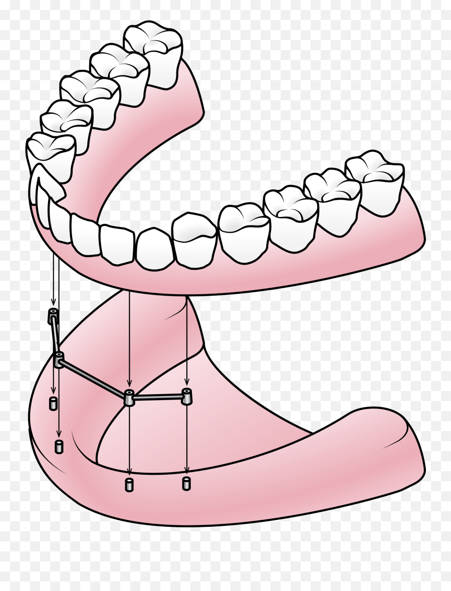 Dentures Valley Dental - Components Of A Denture Png,Dentures Png