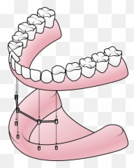 Dentures Valley Dental - Components Of A Denture Png,Dentures Png