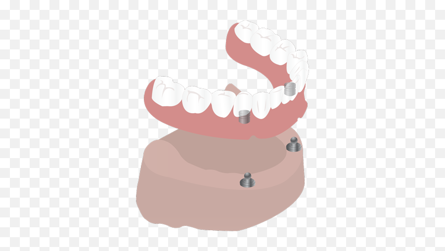Implant Supported Dentures Png
