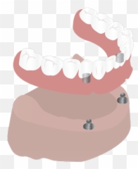Implant Supported Dentures Png