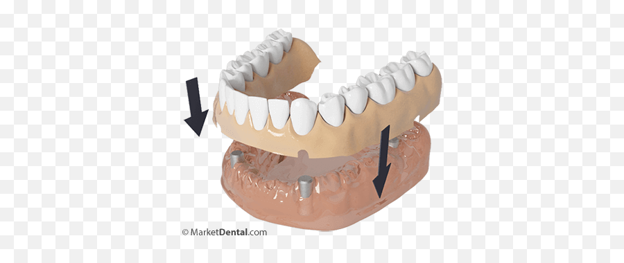 Dentures Edmonton - Buttercream Png,Dentures Png