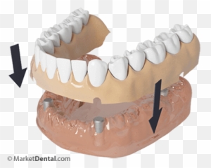 Dentures Edmonton - Buttercream Png,Dentures Png