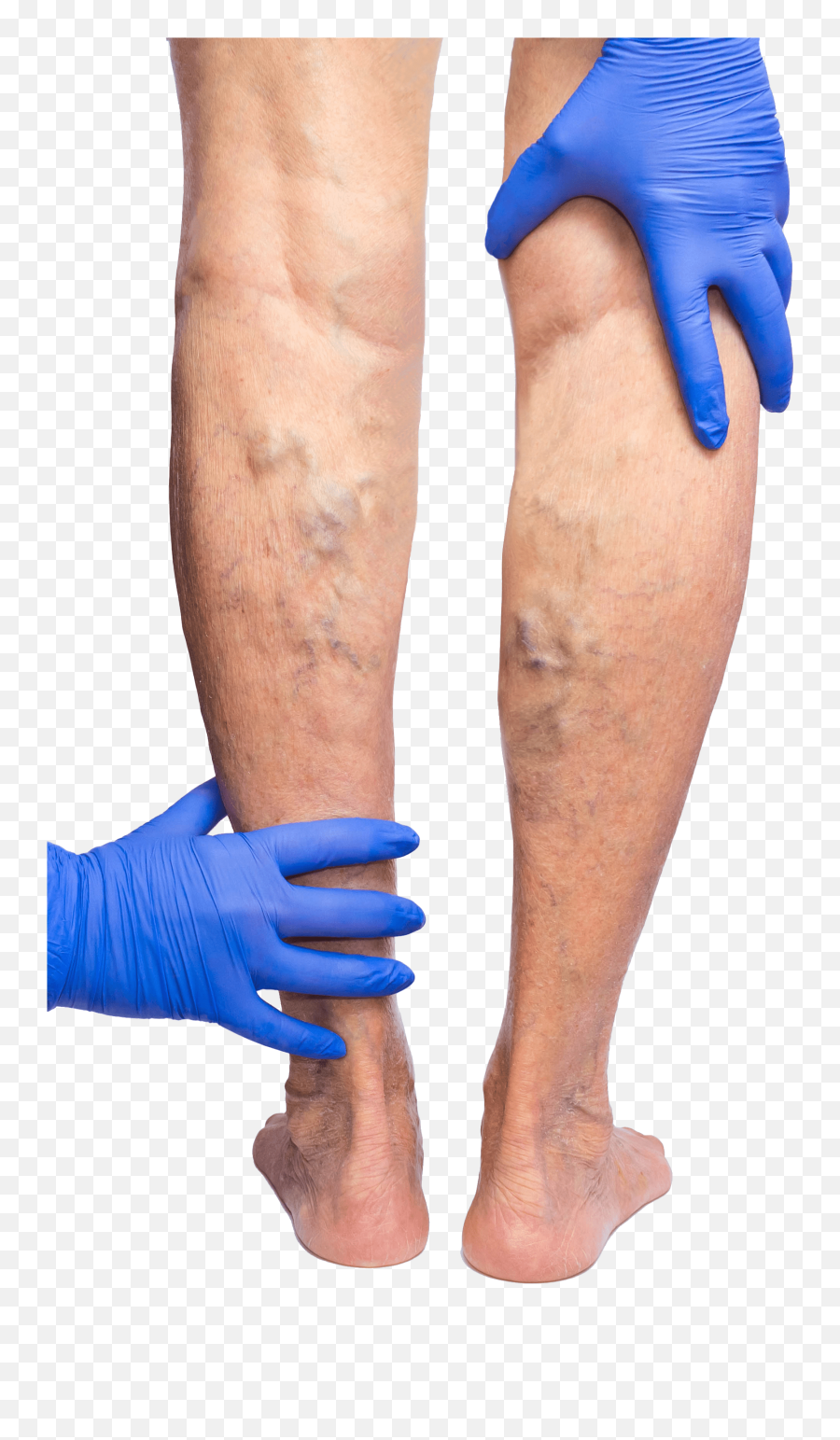 Ocala Vein Center Nagender Reddy Md Facc Fl - Varicose Veins Body Png,Legs Transparent Background