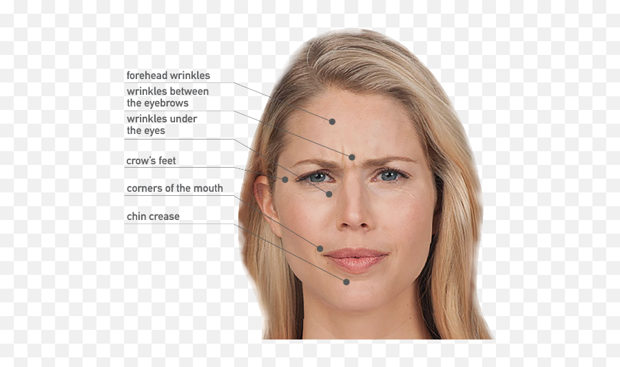 Wrinkle Removal - Lite Botox Before And After Png,Wrinkles Png