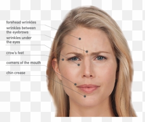 Wrinkle Removal - Lite Botox Before And After png