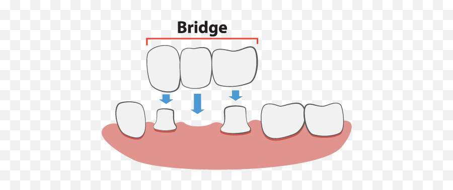 Porcelain Bridges In Lexington Ky - Brewer Family Dental Dental Bridge Illustration Png,Bridge Clipart Transparent