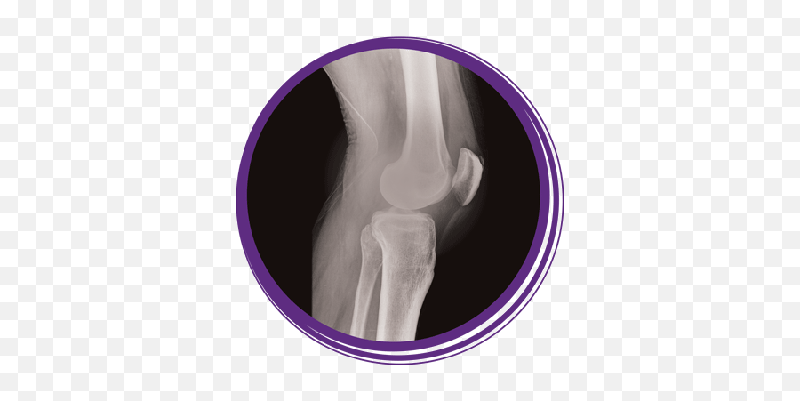 Download Photo Of An X - Ray Of A Knee Joint Rochelle Knee Joint Transparent Background Png,Joint Transparent Background