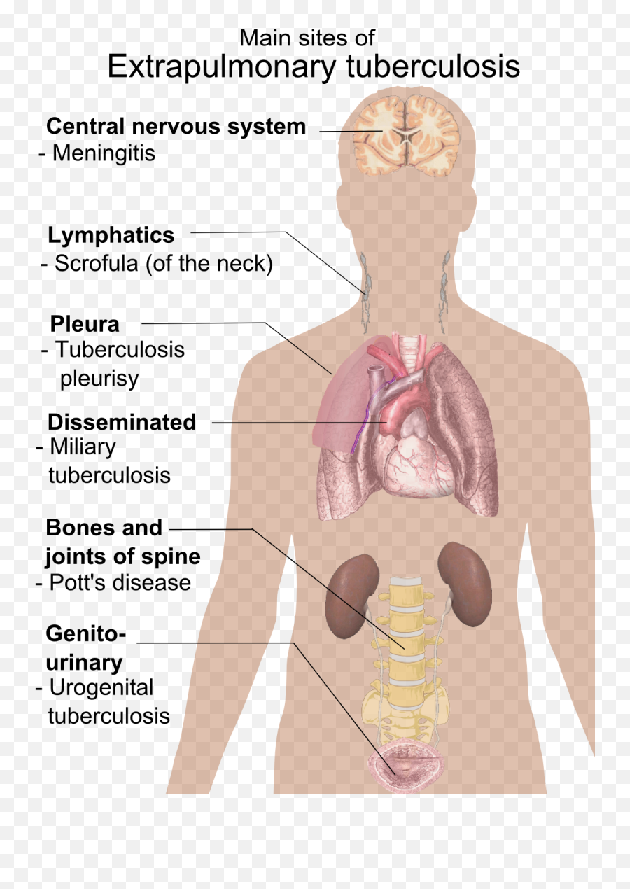Wikimedia Commons - Sign And Symptoms Of Pulmonary Tuberculosis Png,Neck Png