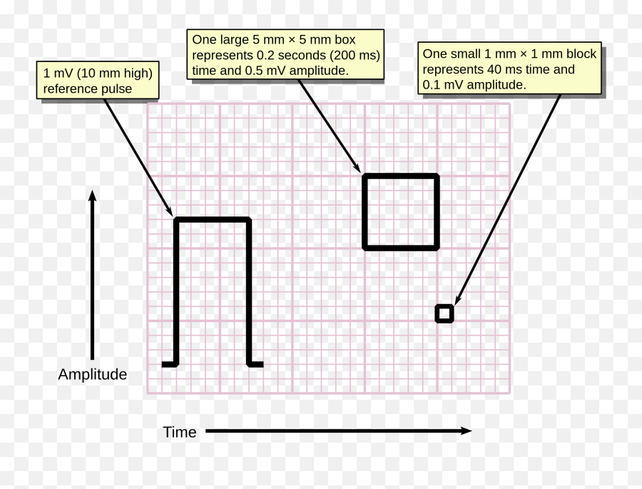 Atrial Fibrillation - 1mm Ecg Png,Ekg Png