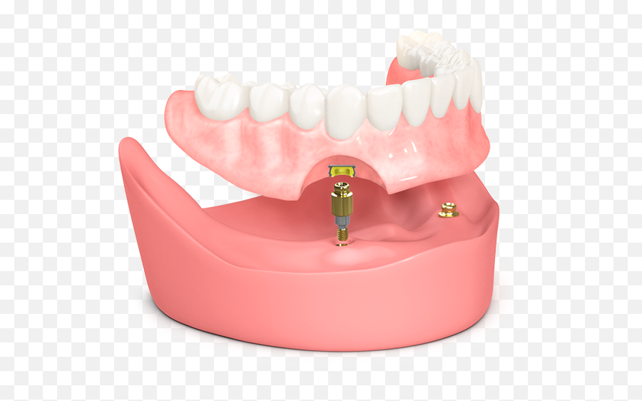 Welcome - Biohorizons Biohorizon Denture Implants Png,Dentures Png