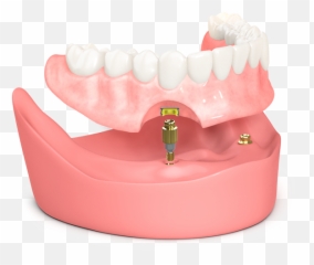 Welcome - Biohorizons Biohorizon Denture Implants Png,Dentures Png