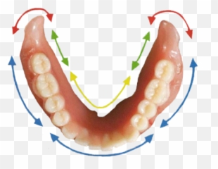What Is A Semcd Or Suction Denture Aldergrove - Lower Suction Denture Png,Dentures Png