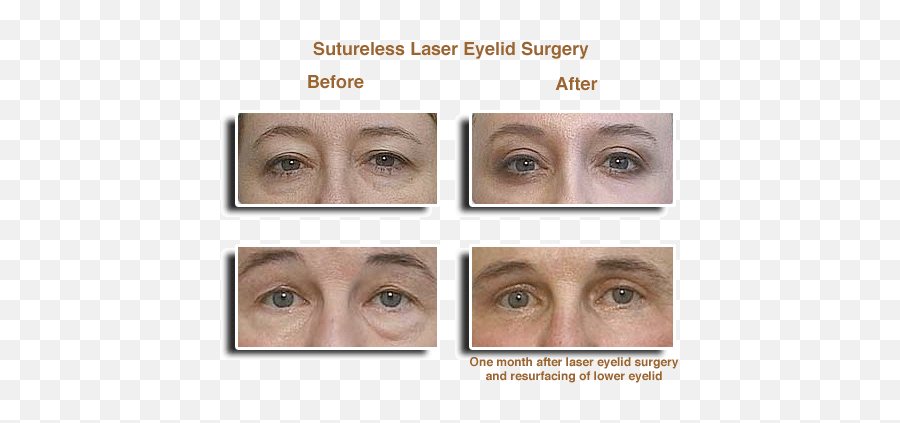 Laser Eyelid Surgery Before U0026 Afters - Eye Laser Surgery Laser Eyes Surgery Before After Png,Eyelid Png