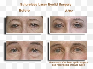 Laser Eyelid Surgery Before U0026 Afters - Eye Laser Surgery Laser Eyes Surgery Before After Png,Eyelid Png