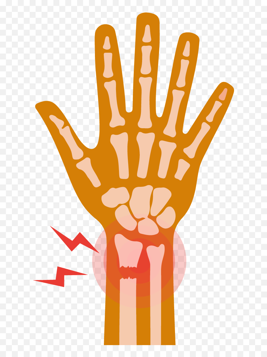 Wrist Fracture What To Do When You Break Your Buoy - Sign Language Png,Broken Parts Icon Transparent
