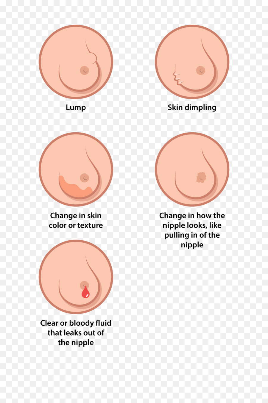 Breast Cancer Illustration Es - Breast Cancer Illustration Png,Breast Cancer Png