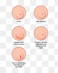 Breast Cancer Illustration Es - png