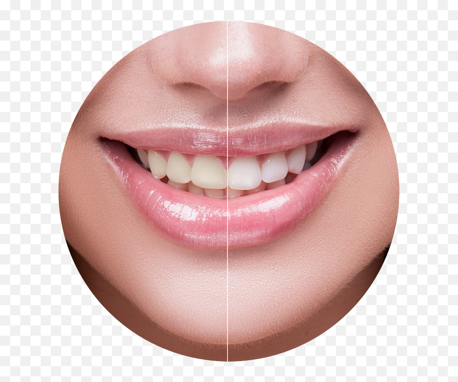 Zoom Whitening In Studio City For A - Charcoal Blast Teeth Whitening Powder Reviews Png,Smile Teeth Png