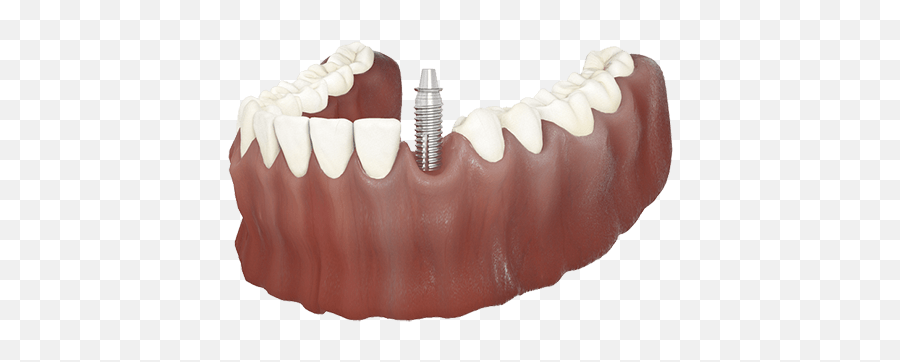 Dental Clinic Bromley Local Dentist Hayes - Tongue Png,Dentures Png