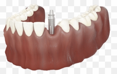 Dental Clinic Bromley Local Dentist Hayes - Tongue Png,Dentures Png