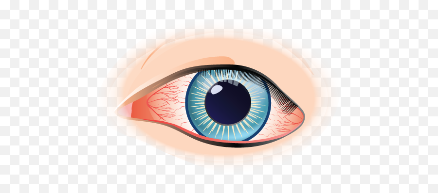 Conjunctivitis Eye Condition Treatment - Dry Png,Eye Wash Icon