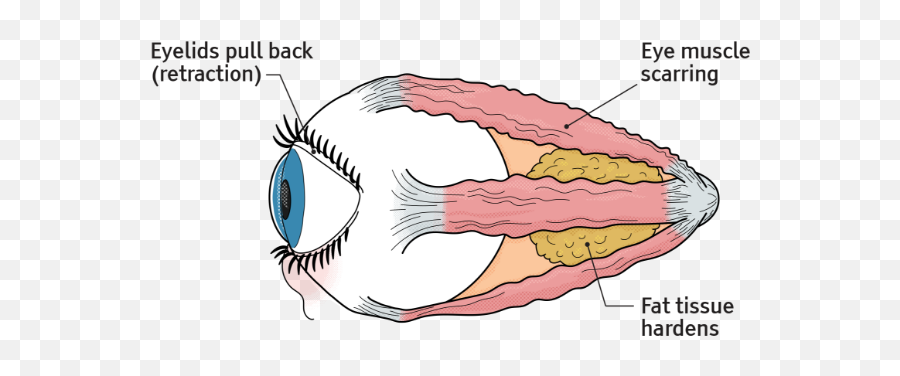 Phases Of Thyroid Eye Disease Tepezza Teprotumumab - Trbw Ugly Png,Showbox Eyeball Icon