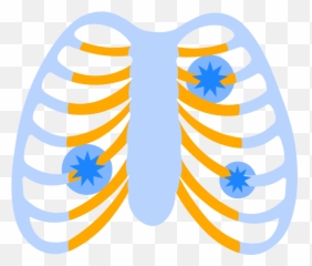 Acute Costochondritis Symptoms U0026 Treatment Of Chest Wall Pain Png