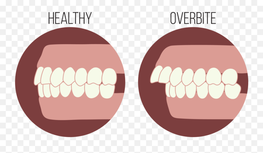 The Steps To - Overbite Png,Smile Teeth Png