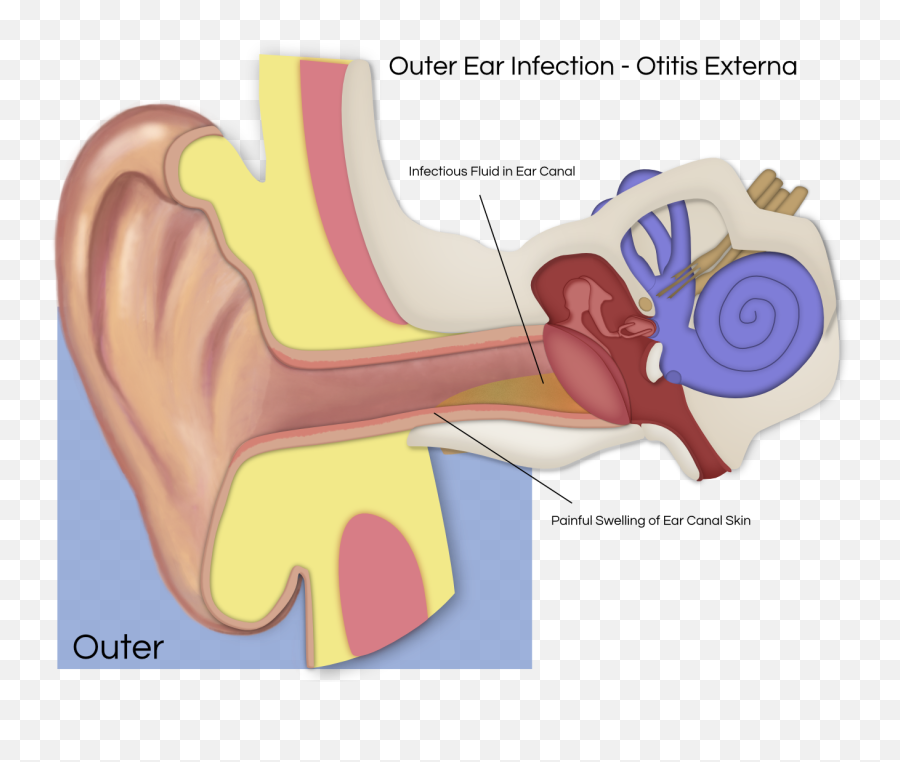 Ear Infections - Ear Pain Otitis Media Png,Ear Transparent