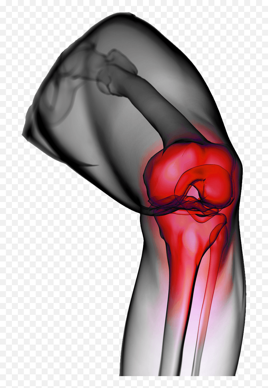 Patellofemoral Joint U2013 Dr Pablo Gelber - Knee Pain No Background Png,Joint Transparent Background