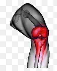 Patellofemoral Joint U2013 Dr Pablo Gelber - Knee Pain No Background png