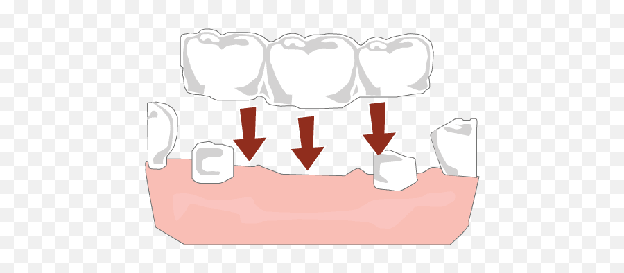 Dental Bridge Procedures Maxus - Aloha Or Language Png,Forth Bridge Restoring An Icon