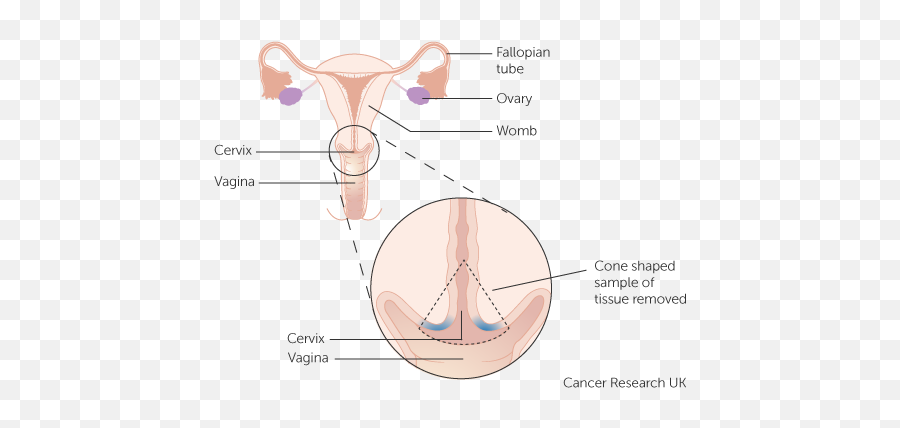 Cone Biopsy Cervical Cancer Research Uk - Transformation Zone Of The Cervix Png,Vagina Png