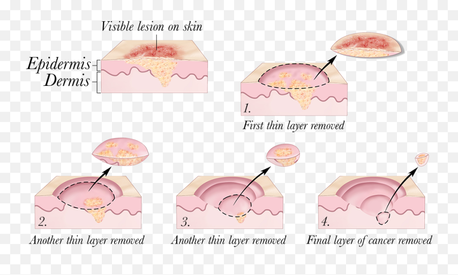 Mohs Micrographic Surgery - Treatments For Skin Cancer Png,Nose Transparent