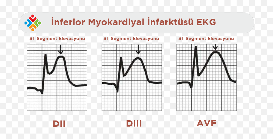 Index Of - St Elevation Png,Ekg Png