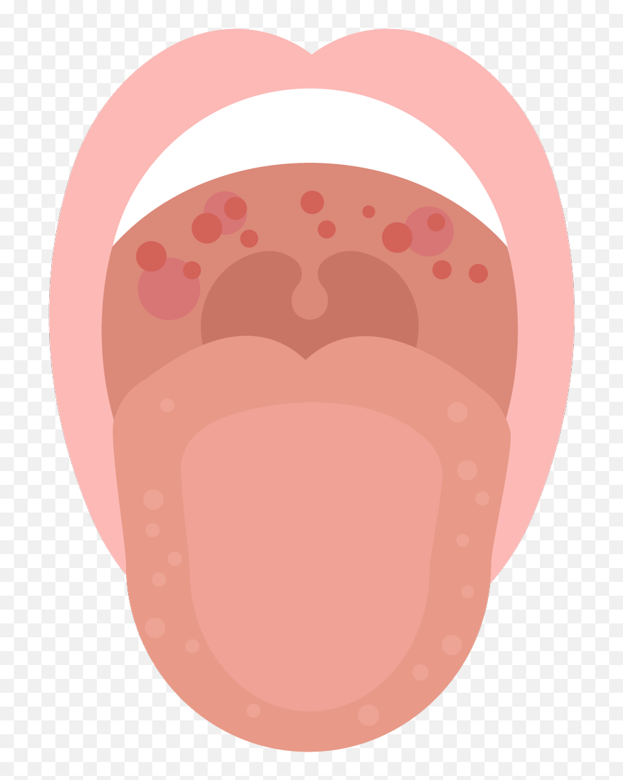 Red Spots In The Mouth How To Treat - Red Spots Roof Of Mouth Png,Red Dot On Phone Icon