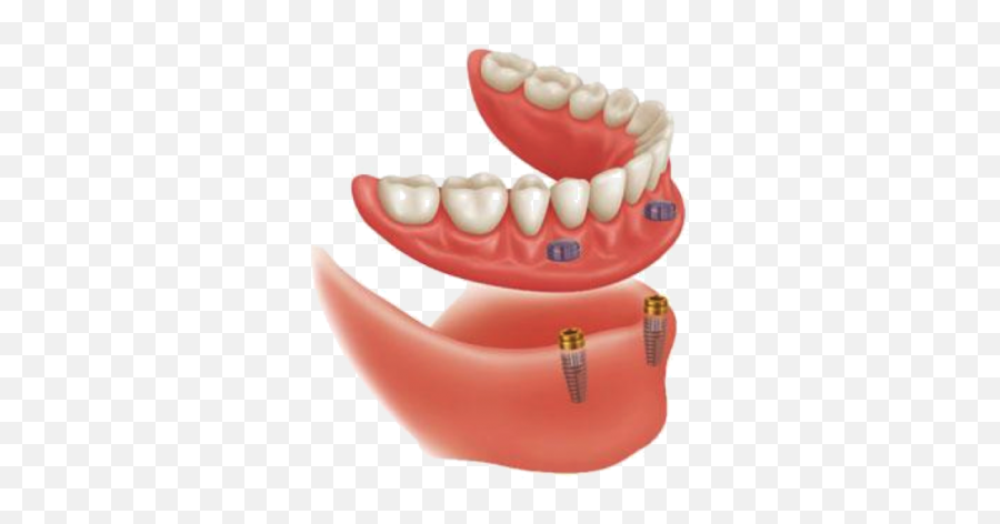 Dentures Archives - Denture Clinic Victoria Locator Overdenture Implant System Png,Dentures Png