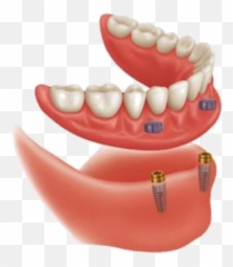 Dentures Archives - Denture Clinic Victoria Locator Overdenture Implant System Png,Dentures Png