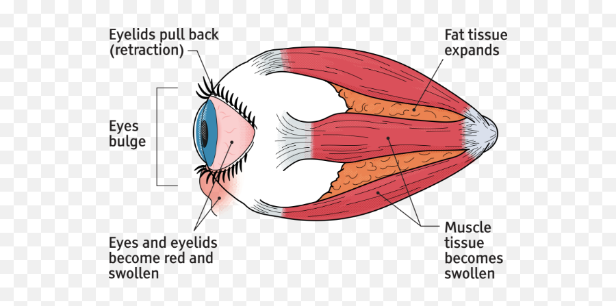 Phases Of Thyroid Eye Disease Tepezza Teprotumumab - Trbw Graves Eye Disease Diagram Png,Showbox Eyeball Icon